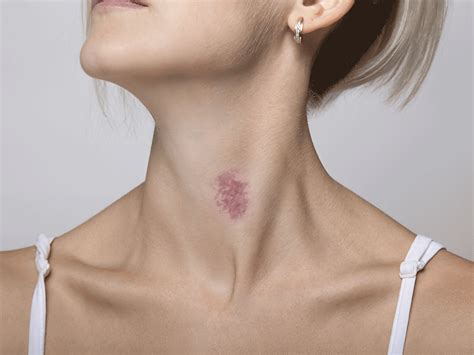 Hickey is an acronym, abbreviation or slang word. Dermatologists Tell Us Exactly How to Get Rid of a Hickey ...