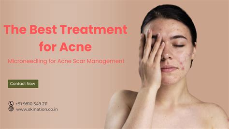 Microneedling For Acne Scar Management Skination Clinic