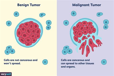 Differences Between A Malignant And Benign Tumor Malignant Tumor