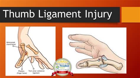 Ligament Injury Of The Thumb UCL Tear In English YouTube