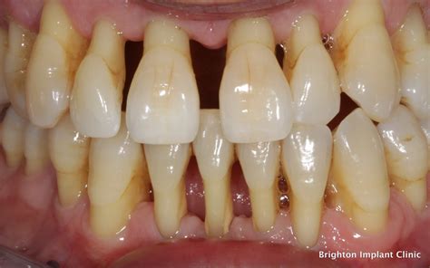 What Causes Periodontal Or Gum Disease