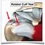 Rotator Cuff Tears And Related Injuries – Howard J Luks MD