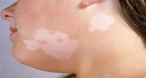 Dry Or White Patches On Skin Causes And Treatments Skincarederm