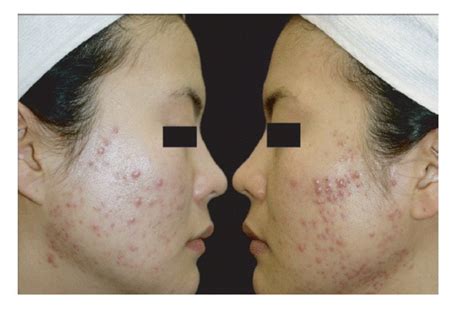 Both Cheeks With Multiple Inflammatory Papules And Acne Scarring Before