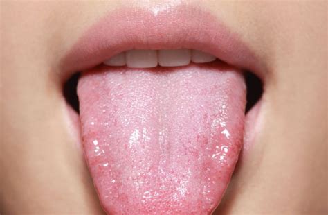 تشخیص بیماری از رنگ زبان در طب سنتی چگونه است؟ تشخیص بیماری سرطان از