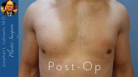 9 Days Post Op Left Gynecomastia Grand Removal The Long Island Gynecomastia Center By Dr