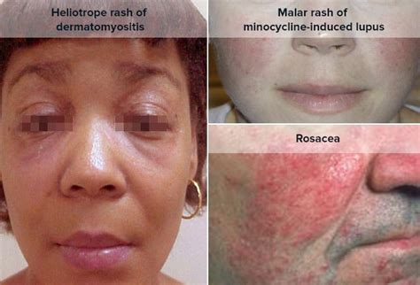 Lupus Malar Rash Vs Rosacea
