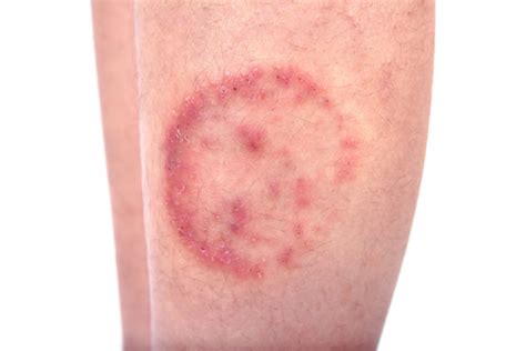 How To Treat Ringworm The Natural Way What You Need To Know