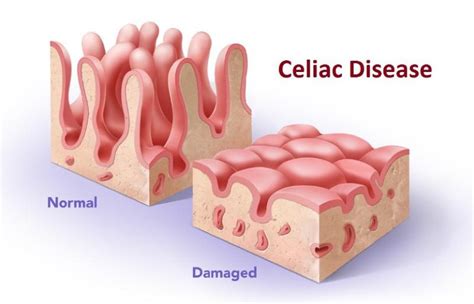 Oral Manifestations Of Celiac Disease Westway Dental