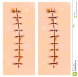 Scars With Staples And Sutures Royalty Free Stock Photos Image 26987468