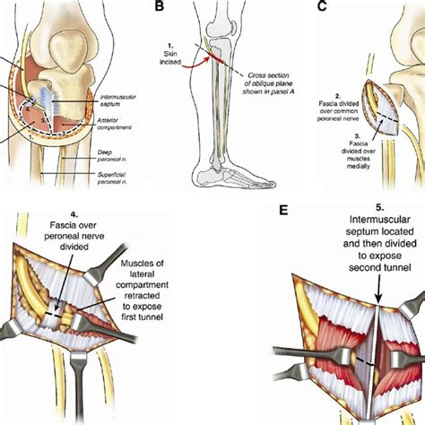 Pdf Prophylactic And Therapeutic Peroneal Nerve Decompression For