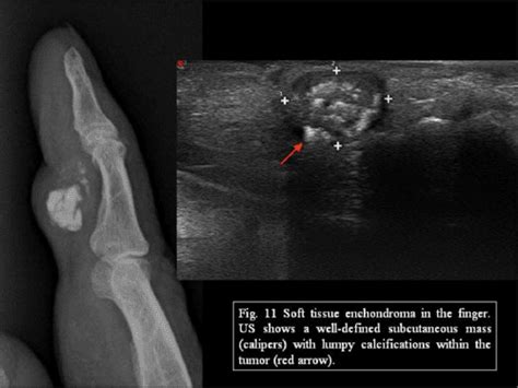 Benign Lesions Of The Subcutaneous Soft Tissue With Calcifications