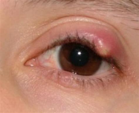 Stye Eye Causes Symptoms Pictures Treatment Prevention Diseases