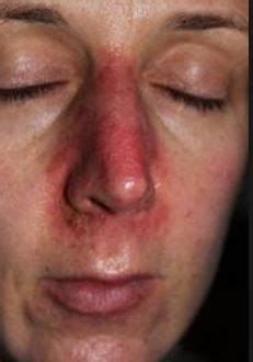 That's where i always struggle and i simply finish up gazing vacant screen for long period of time. Redness around Nose, Cheeks, Mouth, Causes, Pictures, Get ...
