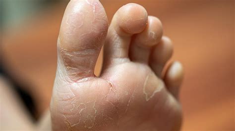 Psoriatic Arthritis Toes