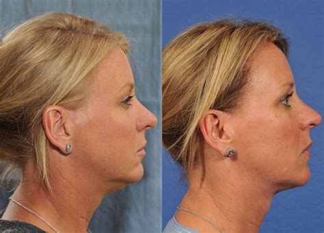 Kybella Before And After 2 Jesse E Smith Md Facs Ft Worth