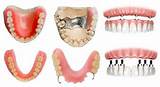 Pictures of Dental Insurance That Covers Dentures