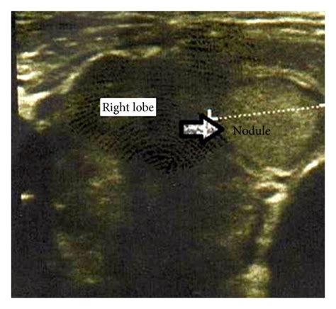 Ultrasonography Of Thyroid Gland Showing Heterogeneous Parenchyma And