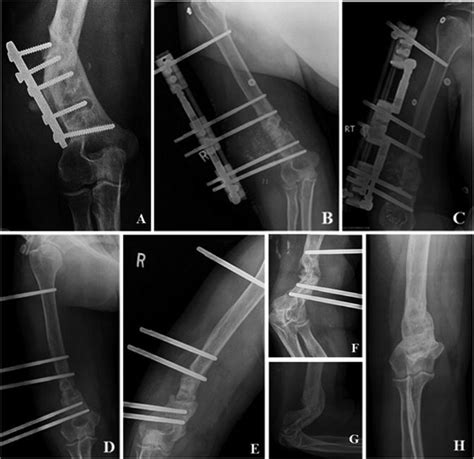 Shortening Of Limb After Fracture Valorant
