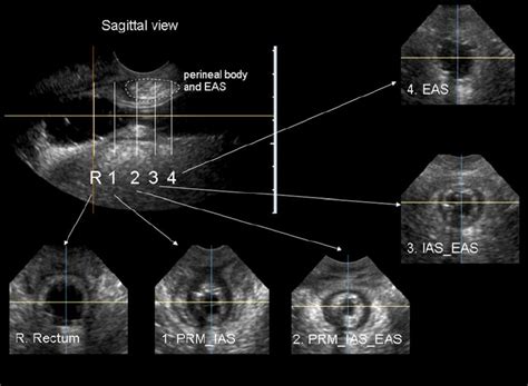 Ultrasound Images In The Sagittal And Axial Planes The Sagittal Image