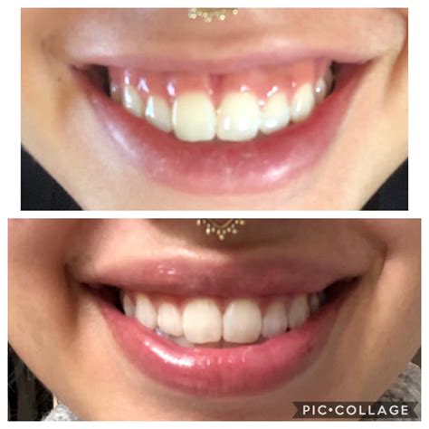 List 94 Wallpaper Lip Flip Before And After Thin Lips Stunning