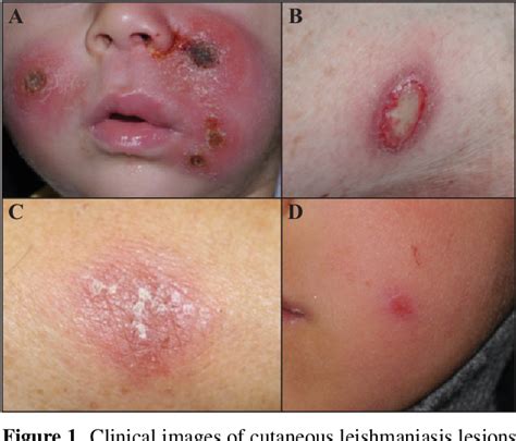 Figure From Eight Cases Of Cutaneous Leishmaniasis Due To Leishmania Infantum With Protean