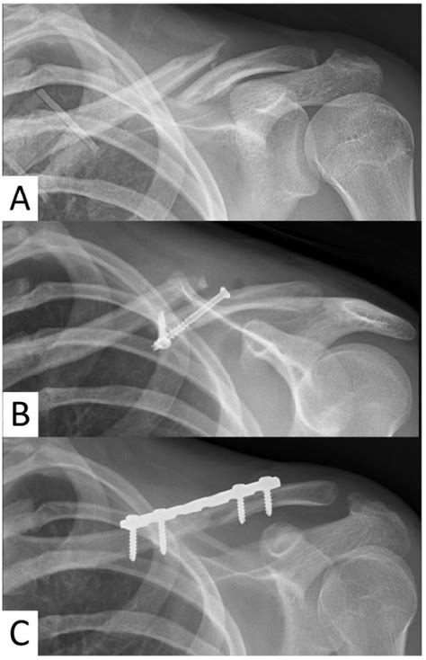 Plain Anteroposterior Radiograph Of The Left Clavicle A Showing The