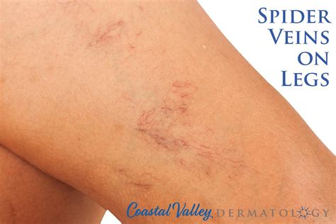 Veins On Face And Legs Coastal Valley Dermatology