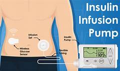 Insulin Delivery Reimagined Ree Medicals Advanced Technology For Diabetes Management