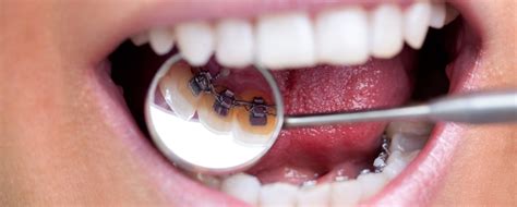 Maybe you would like to learn more about one of these? Lingual Braces - Queensgate Dental Practice