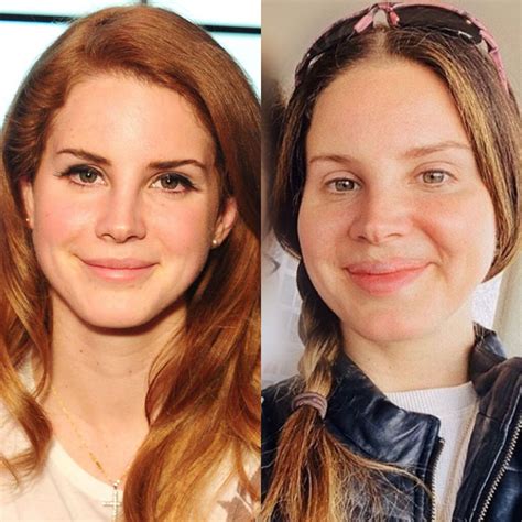 Lana Del Rey Before And After Botched Lana Del Rey Surgery Lana