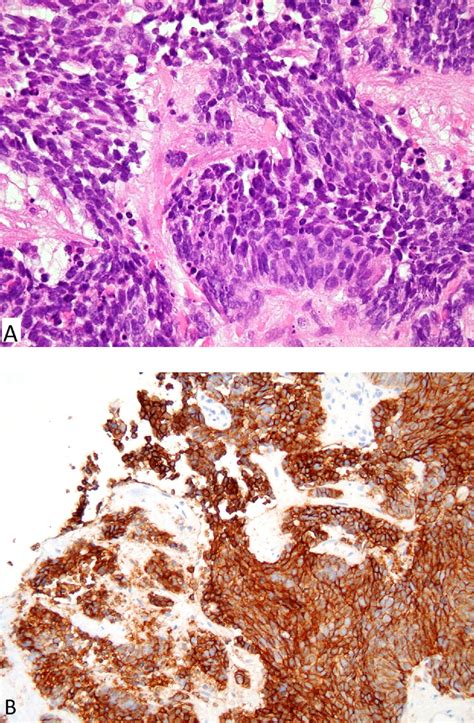 Small Cell Cancer Of The Prostate Urology