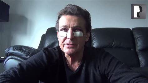 Male Blepharoplasty Eyelid Lift Video Diary Day After Surgery