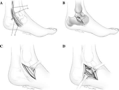 Figure 1 From Fractures Of The Sustentaculum Tali Injury