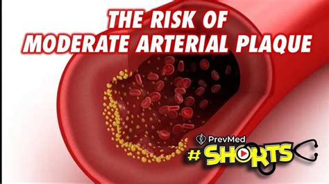 Shorts The Risk Of Moderate Arterial Plaque Youtube
