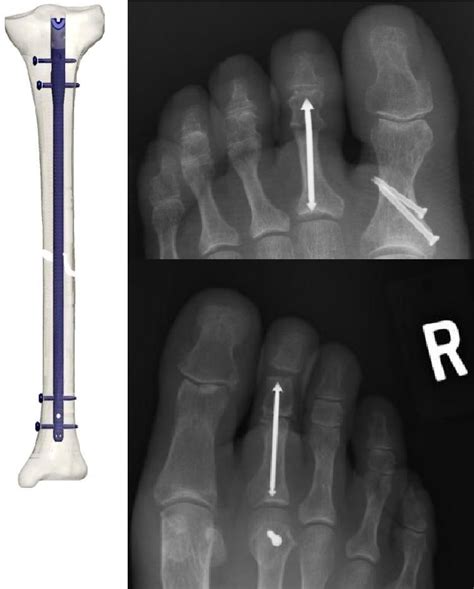 Figure 1 From Intramedullary Rodding Of A Toe Hammertoe Correction