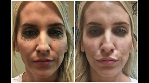 Under Eye Hollow Filler Before And After All You Need Infos
