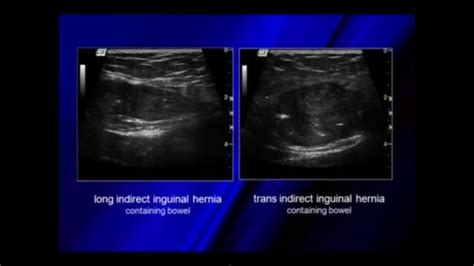 Ultrasound Of Hernias Ultrasound Pandora Screenshot Pandora