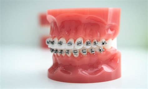 How Do Elastic Bands Work On Braces Jewell Lai