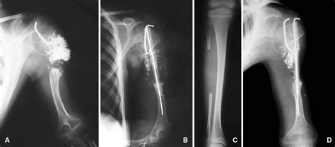 An Aggressive Aneurysmal Bone Cyst Of The Proximal Humerus And Related