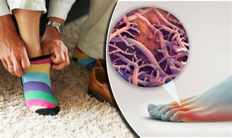 Fungal Infection Causes Wearing Unwashed Socks Among These Six Causes