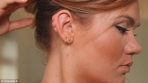 Graduate Is Left With Lumps After Having Her Ear Pierced As A Teenager