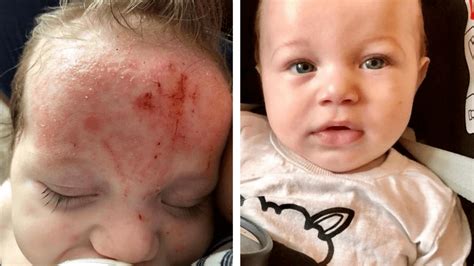 Mom Says Eczema Dream Cream Drastically Healed Her Baby In 24 Hours