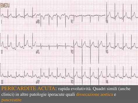 La miocardite è una malattia infiammatoria acquisita che coinvolge il muscolo cardiaco e che riconosce diversi agenti causali, più spesso virus. PPT - Miocardiopatie, farmaci, disionie PowerPoint ...