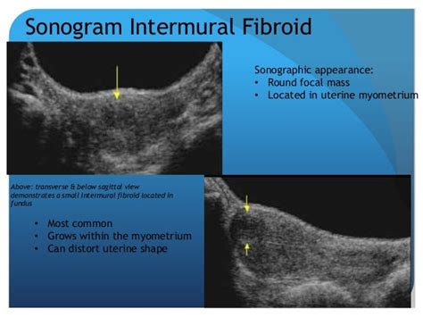 Understanding Uterine Fibriods Andtheir Sonographic Appearances