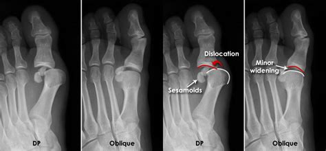 Trauma X Ray Lower Limb Gallery 2 Foot Dislocations