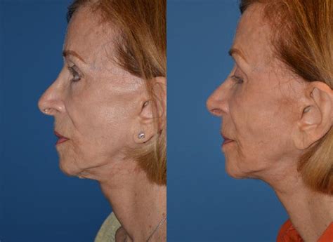 Patient 122406485 Laser Assisted Weekend Neck Lift Before And After