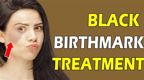 How To Remove Black Birthmark Treatment Dr Swapna Priya Health And