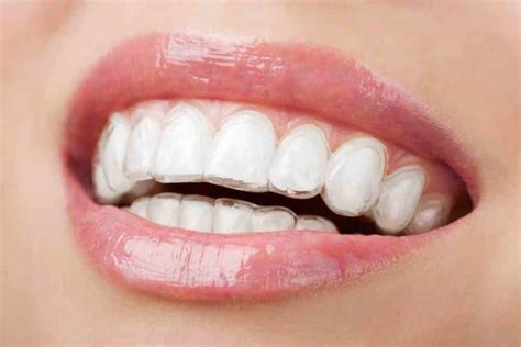 Invisalign Leeds Invisible Braces Clear Brace Dentists £