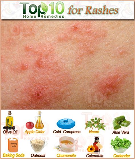 Home Remedies For Rashes Top 10 Home Remedies